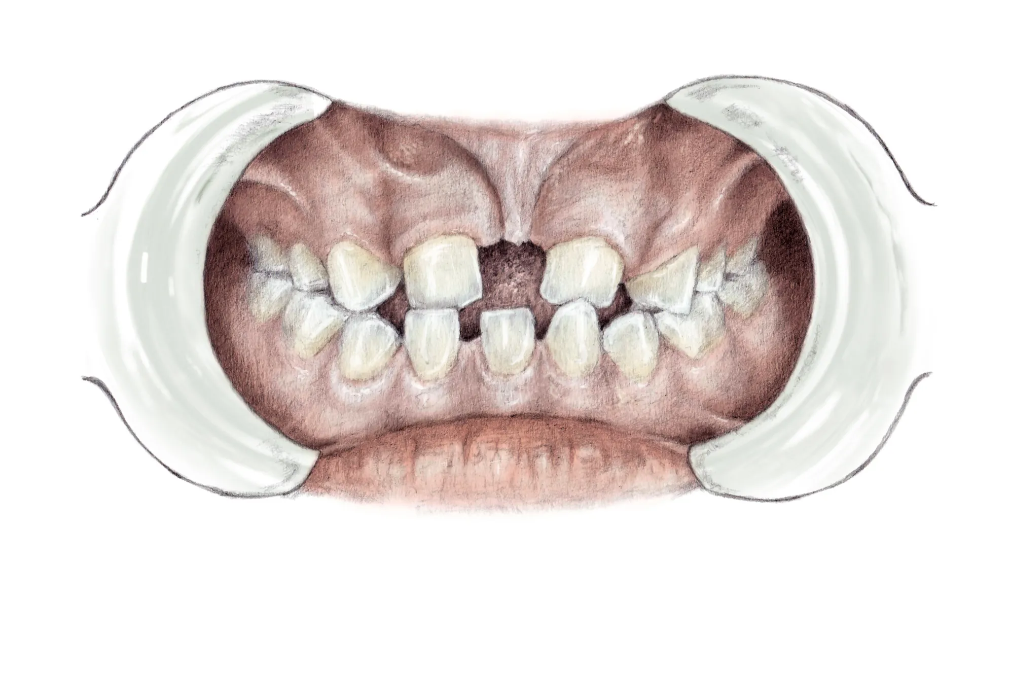 Illustrasjon - munnhule med tenner